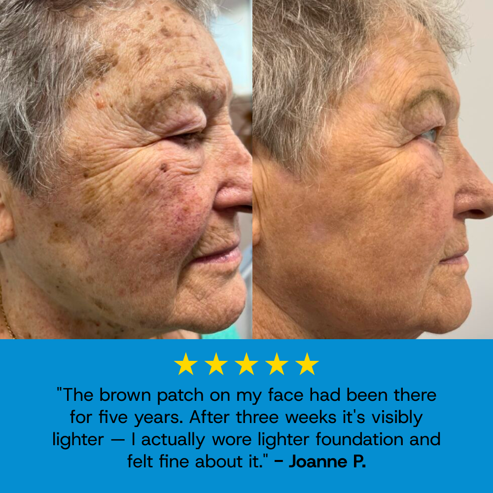 Age Spot Cream