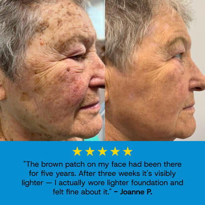 Age Spot Cream