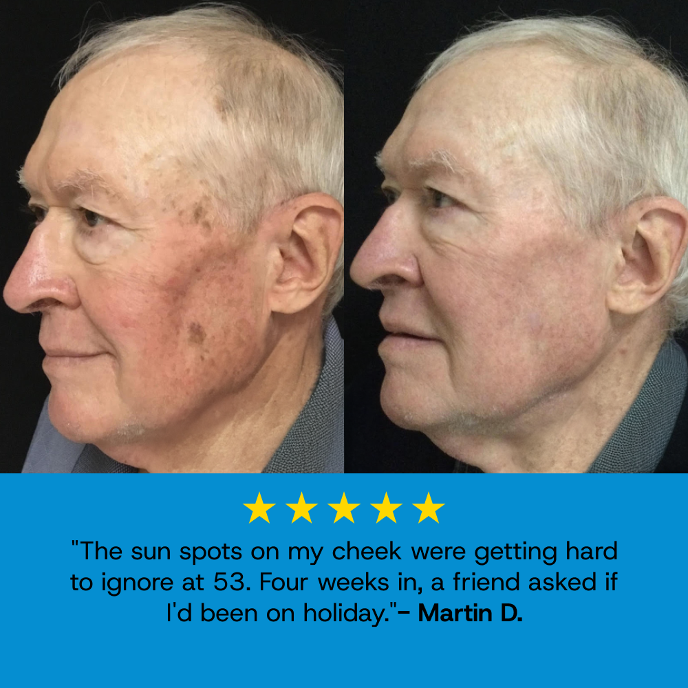 Age Spot Cream